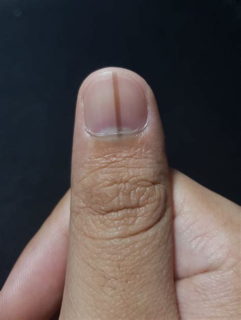 melanoma faint black line on nail